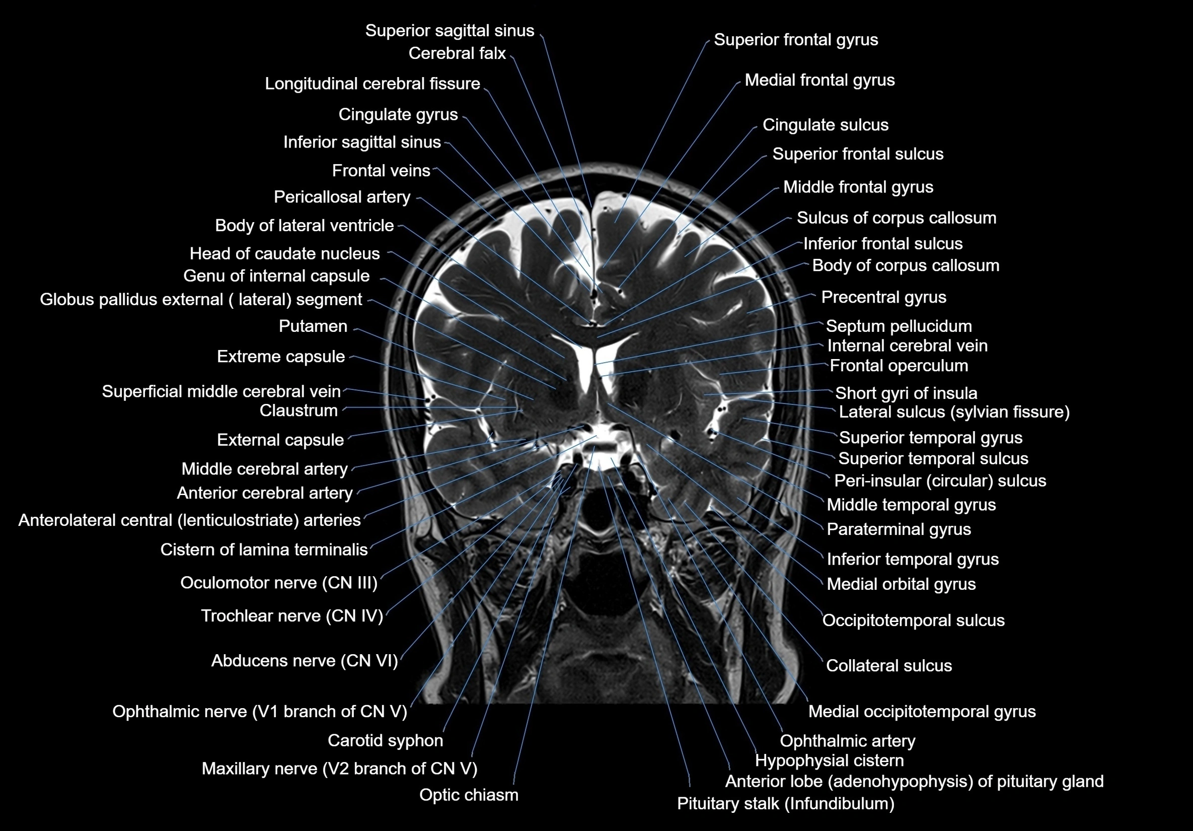 MRI Brain coronal cross sectional labelled anatomy 3T image  -img-00001-00031.webp
